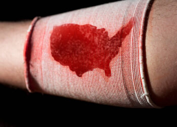 Krvácanie: Ako ho zastaviť a kedy vyhľadať lekársku pomoc